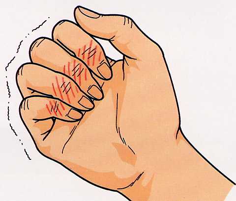 指の痛み
